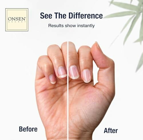 Hand showing nails before and after treatment with clear improvement.